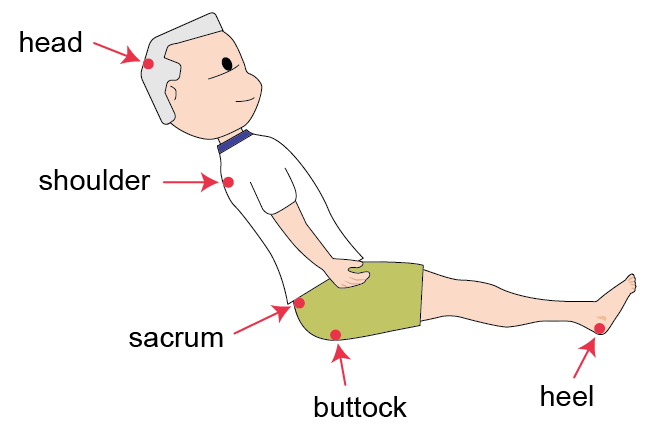 An elderly man in sitting position, red arrows pointing to the common sites of pressure injuries: head, shoulder, sacrum, buttock and heel An elderly man in sitting position, red arrows pointing to the common sites of pressure injuries: head, shoulder, sacrum, buttock and heel