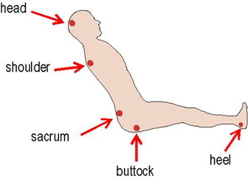 Pressure sores prone areas affected by body position on bed. (a).