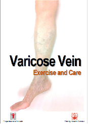 Varicose Vein: Exercise and Care