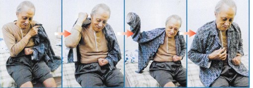 the four steps one-hand technique in dressing upper garment by an elderly with left-sided hemiplegia