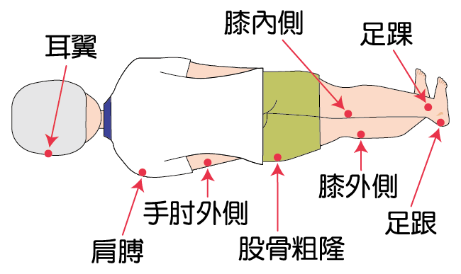 一位男长者侧卧，红色箭咀指着压力性损伤常见的位置：耳翼、肩膊、手肘外侧、股骨粗隆、膝内侧、膝外侧、足踝及足跟