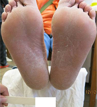 圖中顯示一對患有足癬的腳掌底部，整個腳掌底部的皮膚均乾裂脫落。