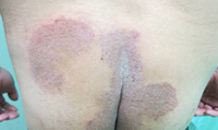 圖中顯示患有股癬的臀部，左臀的上方、右臀的中央及兩臀之間的股溝均有紅色不規則形狀的皮疹，右臀中央及股溝的皮疹上有乾裂的皮膚。