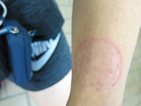 圖中顯示患有體癬的左前臂，前臂近手腕的位置有一紅色的環狀皮疹。