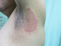圖中顯示患有體癬的左邊腋下，腋下的後半部分有一紅色的圓形皮疹，皮疹上的皮膚呈現糠狀的粗粒。